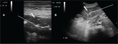 Prospective study on the impact of BEAM versus FEAM conditioning on occurrence of neutropenic enterocolitis and on transplant outcome in lymphoma patients